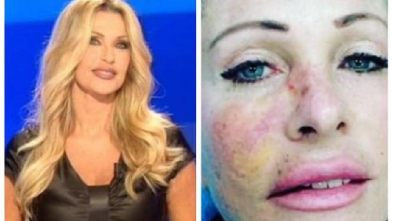 paola ferrari la foto choc ecco il mio viso col cancro alla pelle cronaca quotidiano net